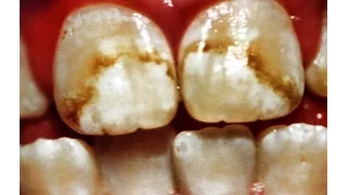 Зубы и фтор (Fluoride: Poison On Tap).