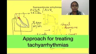 Treatment for tachyarrhythmias | Cardiovascular Medicine