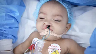 A New Beginning: Baby's Cleft Lip Surgery Experience