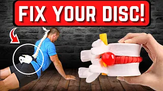 Fix Your Herniated Disc: 3 Self-Diagnosis Techniques and Remedies