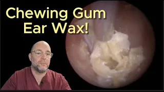 CHEWING GUM EAR WAX! 231 #ear #earwax #earwaxremoval #earcleaning  #asmr #asmrearwax #fyp