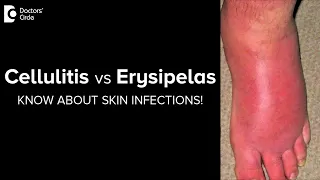CELLULITIS vs ERYSIPELAS. Know more about these SKIN INFECTIONS-Dr. Rajdeep Mysore | Doctors' Circle