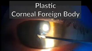 Plastic Corneal Foreign Body Removal with a Needle