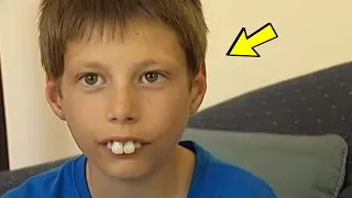 Над мальчиком все издевались из-за его зубов, спустя 5 лет его не узнать!