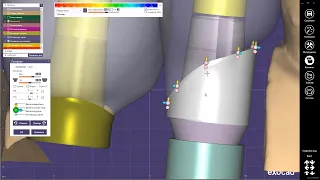 EXOCAD Работа с профилем прорезывания, коронки на винтовой фиксации