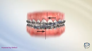 Midline Correction Elastic