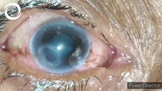 Peripheral corneal thinning