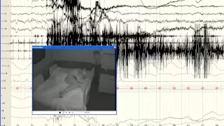 Lesional REM sleep behavior disorder localizes to the dorsomedial pons