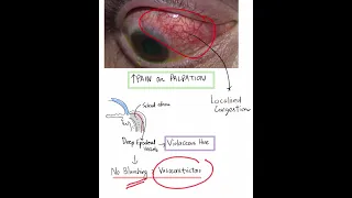 Scleritis - Case Discussion In A Minute #Mustknow #Shorts