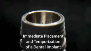 EXPLICIT - Immediate placement - Dental Implant