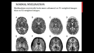 White Matter Diseases 1