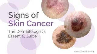 What are the 6 Warning Signs and Symptoms of Skin Cancer? - A Video Guide by Miiskin