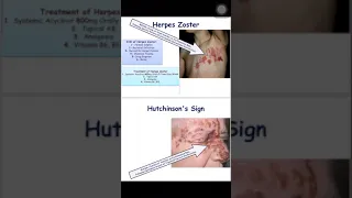 Slides : Herpes zoster