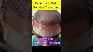 Best Hair Transplant Surgery in Delhi #shorts
