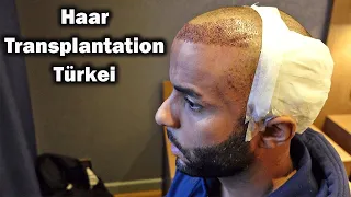 Haartransplantation Türkei | Erfahrungen bei Dr. Serkan Aygin
