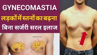 Gynecomastia को कैसे कम करें | Gynecomastia Treatment Without Surgery | How To Cure Gynecomastia