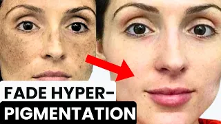 HOW TO GET RID OF HYPERPIGMENTATION, MELASMA, DARK SPOTS, SUN SPOTS, POST-INFLAMMATORY ERYTHEM