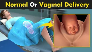 Normal Vaginal Childbirth - How Baby Is Delivered Form Female Body?