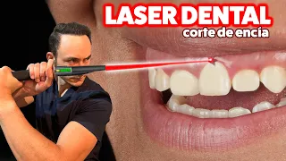 Alargamiento de encía con láser, lo más nuevo en la odontología láser.