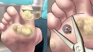 Satisfying! foot wart treatment | screw nail removal | tingle sound