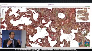 Pathology Insights: Nonspecific Interstitial Pneumonia (NSIP) with Sanjay Mukhopadhyay, MD