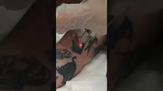 What a thrilling tattoo removal #shorts #tattooremoval