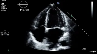 TTE - Aortic Valve Endocarditis with Aortic Regurgitation