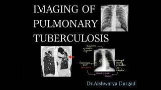 Imaging of pulmonary tuberculosis- A detailed radiologic review | Checklist for reporting |