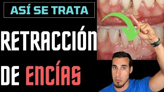 ENCÍAS RETRAÍDAS - Tratamiento con INJERTO antes y después