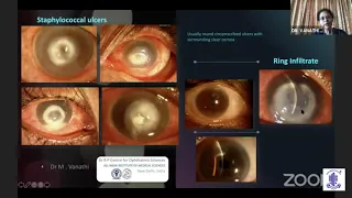 AIOS ARC - Cornea Update Series -Dr.Vanathi.M