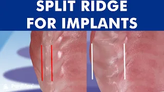 Dental implant placement with bone ridge splitting ©