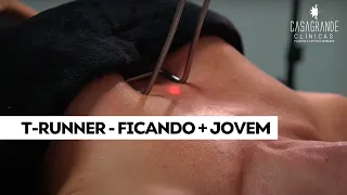 Fotona T-Runner: Tecnologia Avançada para Rejuvenescimento da Pele 🌟