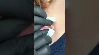 Pimple popping satisfying video new C#191