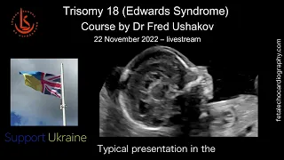 Trisomy 18 (Edwards Syndrome) Course: Special Fundraising Event for Ukraine Support. 22/11/22