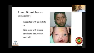 Congenital eyelid coloboma