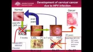 Cervical Cancer Screening. Is this the end of the pap smear?