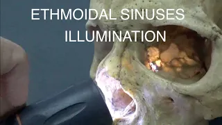 ETHMOIDAL SINUSES - ILLUMINATION