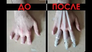 ПРОТЕЗ ПАЛЬЦА. Функциональный протез на 3 пальца. Обморожение (указательный, средний, безымянный)