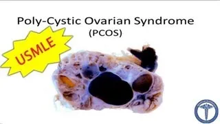 Polycystic Ovarian Syndrome (PCOS) - MADE EASY