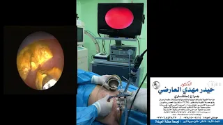 PCNL سحب حصاة الكلية بالناظور  د.حيدر مهدي العارضي