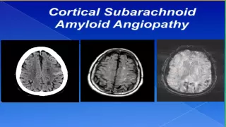 Cortical Subarachnoid Hemorrhage by Sebastian Koch, MD