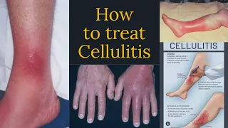 iv antibiotics for cellulitis