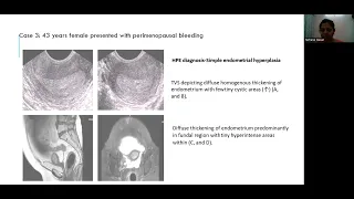 Farhana Hasan | MRI in perimenopausal bleeding & correlation with TVS ultrasound #mriteachingcourse