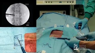 Percutaneous Screw Placement - Hyun Bae, MD