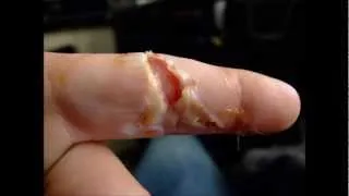 Rope Burn-Fail lost finger