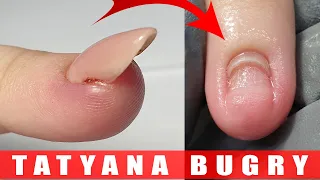 Nail TORN OFF Nail Bed 😱 | Correcting Nails Growing Upward