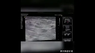 suspicious axillary lymph node | ultrasound case