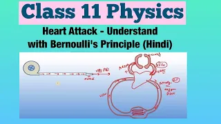 Heart Attack - Understand with Bernoulli's Principle (Hindi) | Class 11 Physics