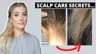 How an Unhealthy Scalp Causes Hair Damage & How to Fix An Itchy, Flaky Scalp