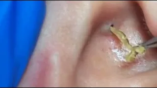 TOP OF BLACKHEADS REMOVAL FROM THE EAR 😨 #2 #relaxing  #blackheads